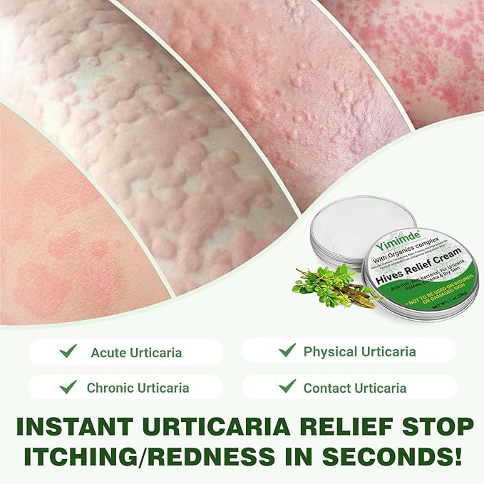 Hives Relief Urticaria Cream, Fast Acting Hives Treatment & Anti-Fungal Anti-Itch Cream for Allergic Rashes, Eczema, Itchy Skin, Redness & Swelling | All Natural Herbal Organic Complex, 1 Oz