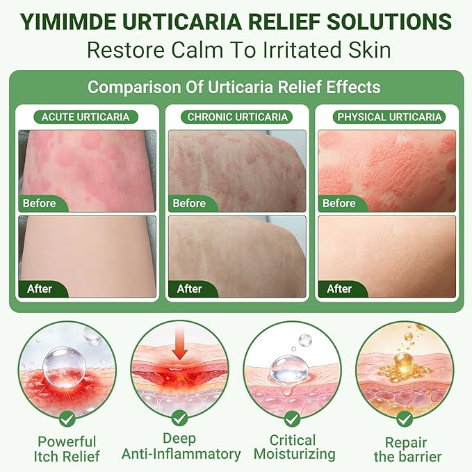 Hives Relief Urticaria Cream, Fast Acting Hives Treatment & Anti-Fungal Anti-Itch Cream for Allergic Rashes, Eczema, Itchy Skin, Redness & Swelling | All Natural Herbal Organic Complex, 1 Oz