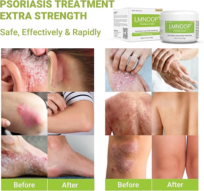 Psoriasis Cream, Maximum Strength Treatment Moisturizing Cream for Psoriasis, Dermatitis, Rash, Anti-Itch, Redness, Flaking, Scaling, Fast Acting Relief for Irritated, Dry Skin 3.53OZ
