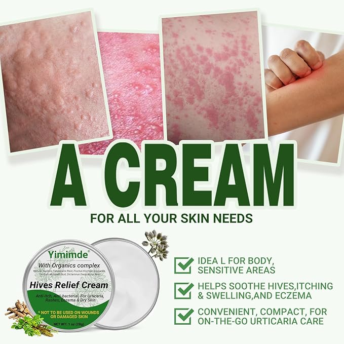 Hives Relief Urticaria Cream, Fast Acting Hives Treatment & Anti-Fungal Anti-Itch Cream for Allergic Rashes, Eczema, Itchy Skin, Redness & Swelling | All Natural Herbal Organic Complex, 1 Oz