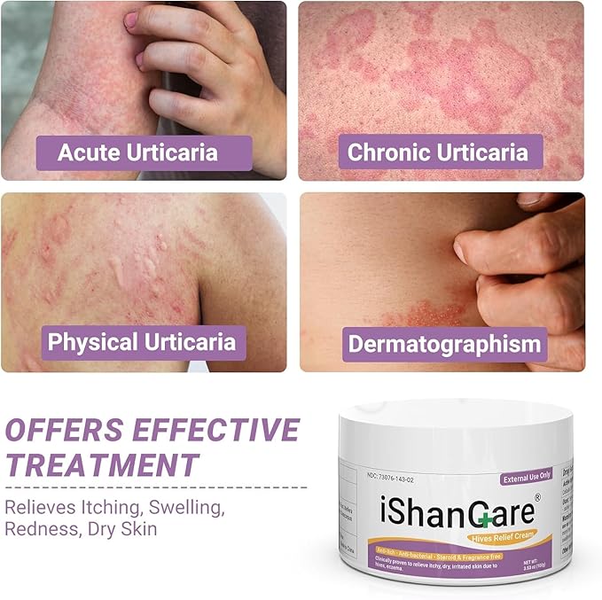 ishancare Urticaria Cream, Fast Acting Relief of Hives, Allergic Rashes, Itchy Skin, Redness, Swelling, Anti Fungal Hives Cream with All Natural Herbal Ingredients, 3.53 Oz