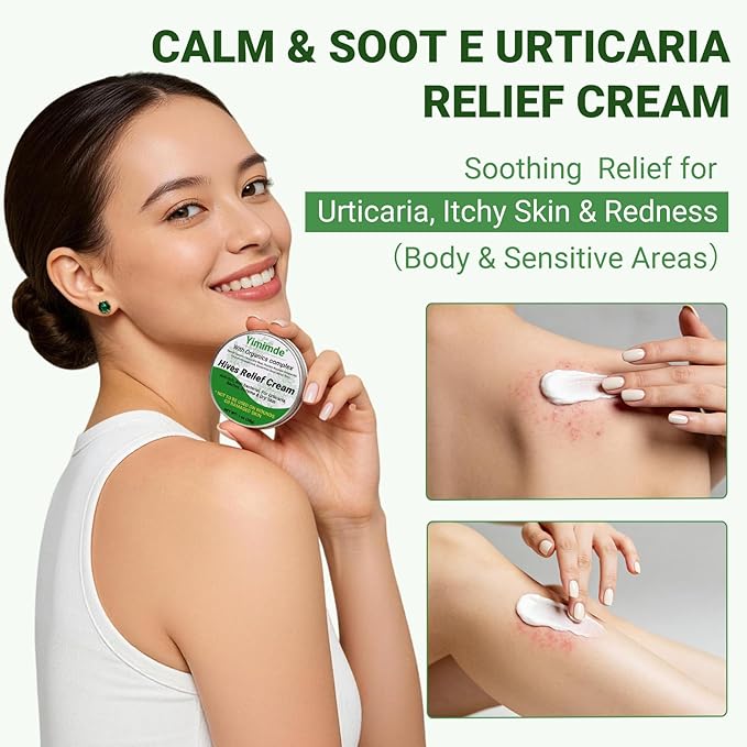 Hives Relief Urticaria Cream, Fast Acting Hives Treatment & Anti-Fungal Anti-Itch Cream for Allergic Rashes, Eczema, Itchy Skin, Redness & Swelling | All Natural Herbal Organic Complex, 1 Oz