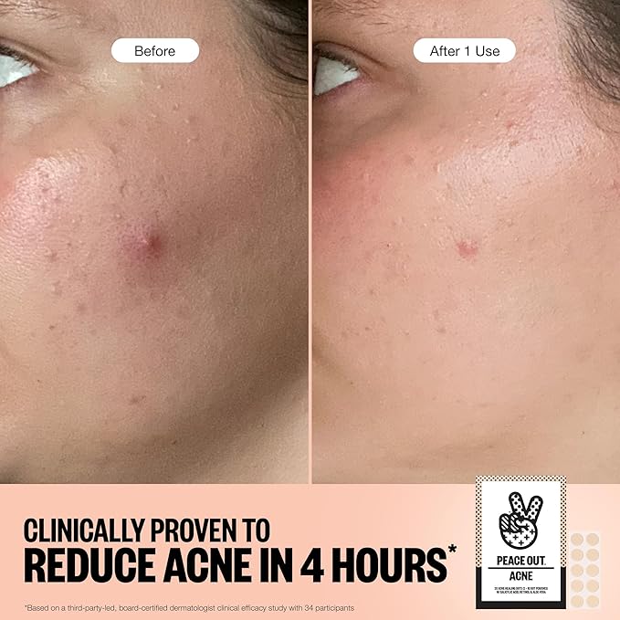 PEACE OUT Acne Healing Dots Hydrocolloid Pimple Patches, Acne Spot Treatment with Salicylic Acid, Retinol, and Aloe Vera for Blemishes and Breakouts, 20 Count